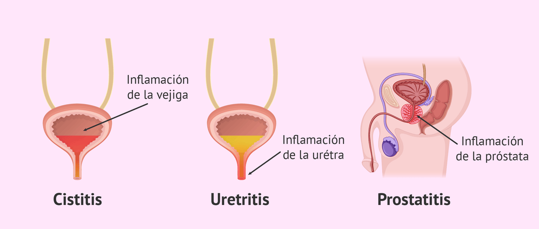 Cómo Aliviar los Síntomas de la Cistitis y Prostatitis de Manera Natural