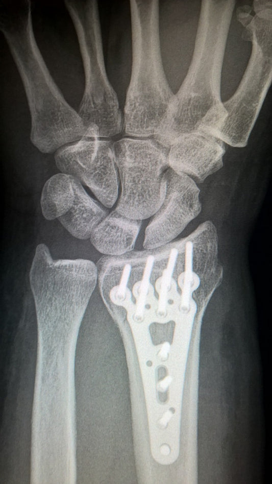 Radiografía de muñeca abierta y débil