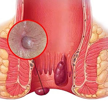 Remedios Efectivos para las Hemorroides: Cómo Aliviar los Síntomas de Forma Natural