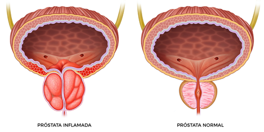 Cómo Combatir la Inflamación de la Próstata con Soluciones Naturales