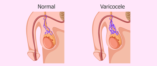 Cómo Prevenir y Tratar el Varicocele Sin Cirugía